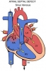 atrial septal defekt / #130633