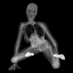 x ray