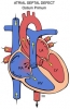 atrial septal defekt / #130631