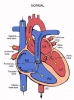 atrial septal defekt / #130634